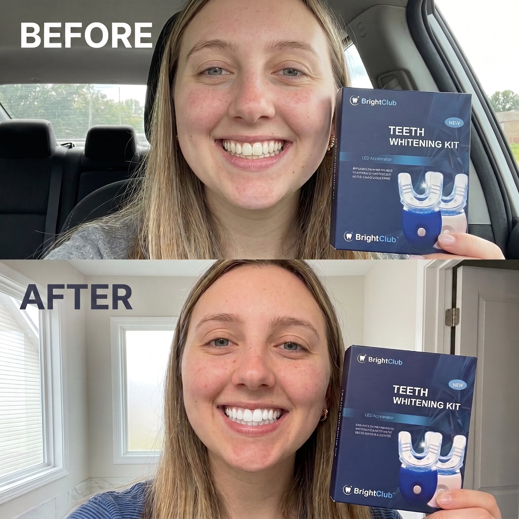 BrightClub Teeth Whitening Kit