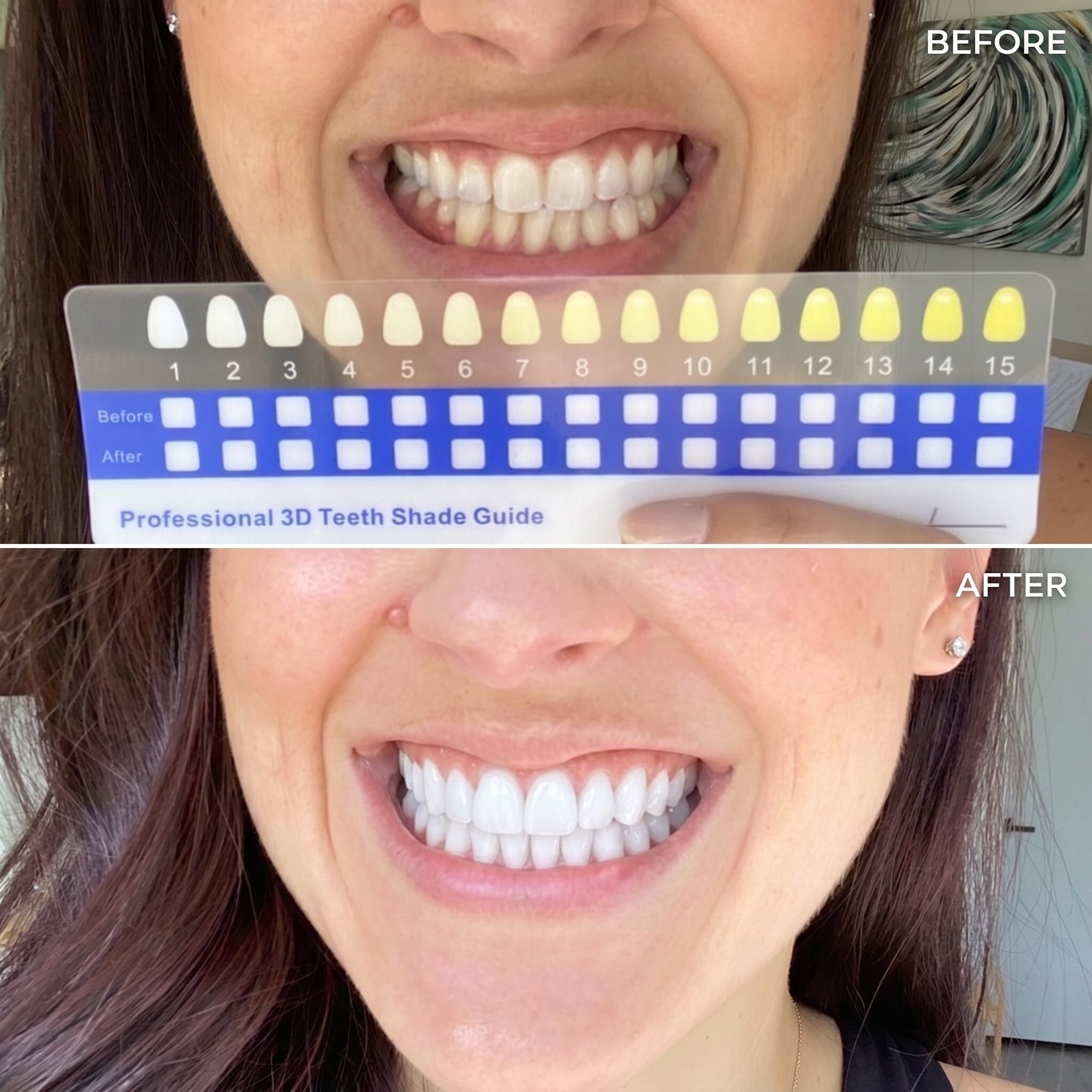BrightClub Teeth Whitening Kit